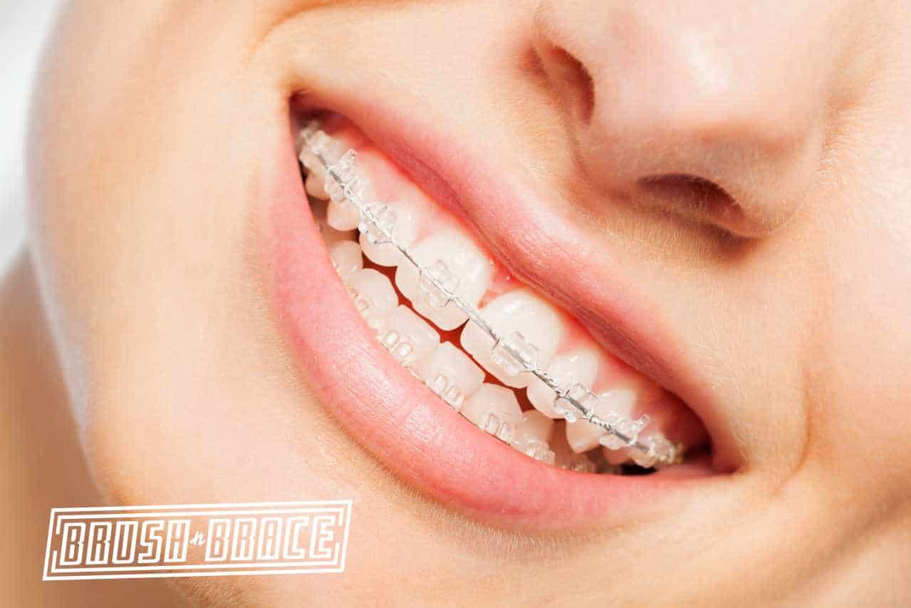 picture of a girl with clarity braces
